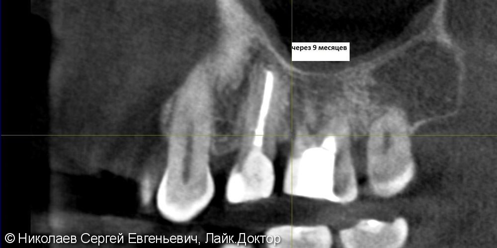 Эндодонтическое лечение 26 зуба, "киста", до и после - фото №8