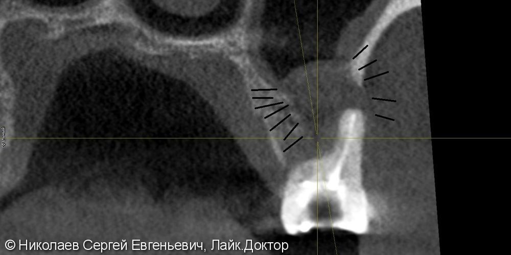 Эндодонтическое лечение 26 зуба, "киста", до и после - фото №9