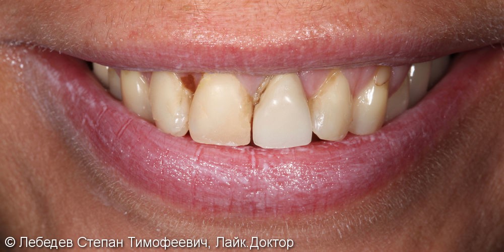 Тотальная реабилитация зубов и преображение улыбки - фото №1