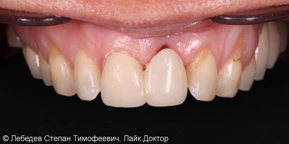 Тотальная реабилитация зубов и преображение улыбки - фото №2