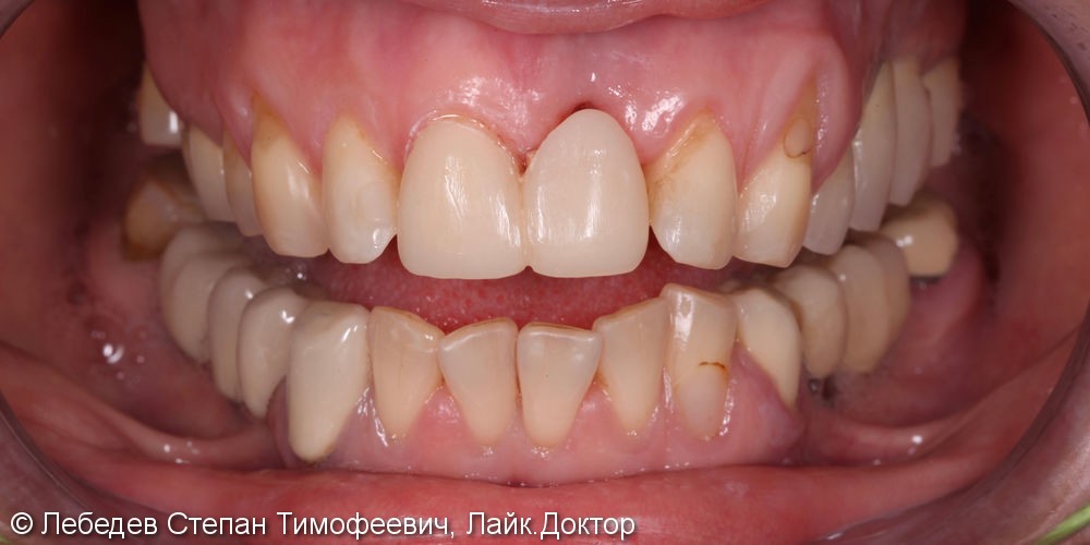 Тотальная реабилитация зубов и преображение улыбки - фото №3