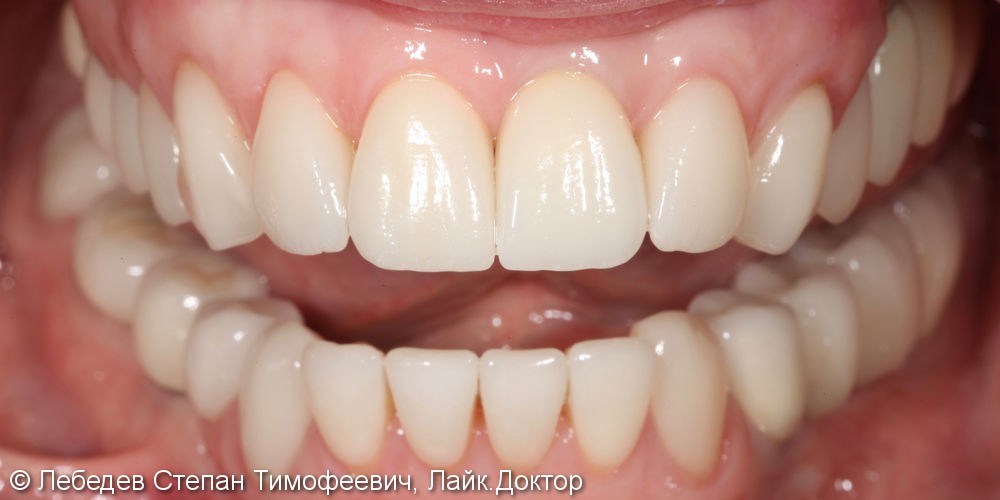 Тотальная реабилитация зубов и преображение улыбки - фото №4