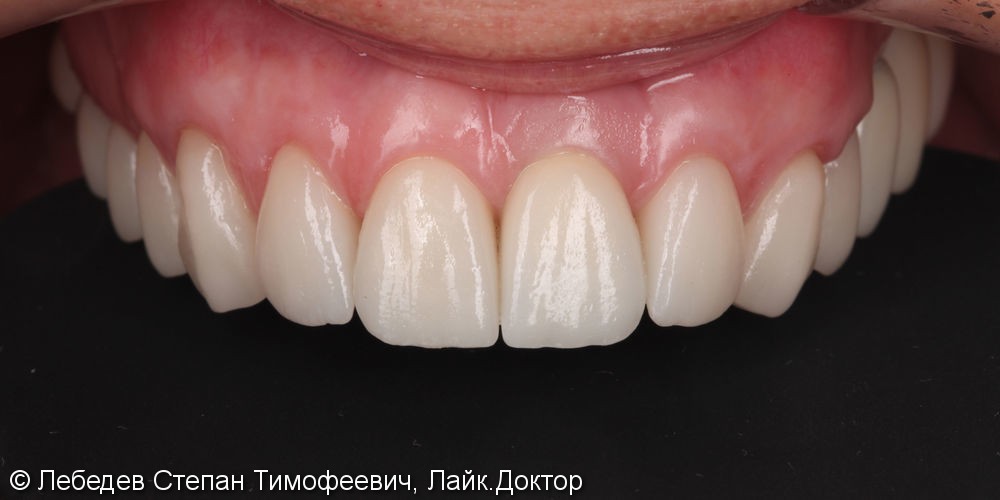 Тотальная реабилитация зубов и преображение улыбки - фото №5