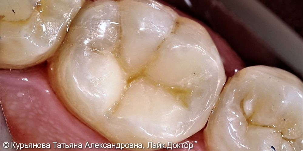 Лечение среднего кариеса зуба 4.6 - фото №3