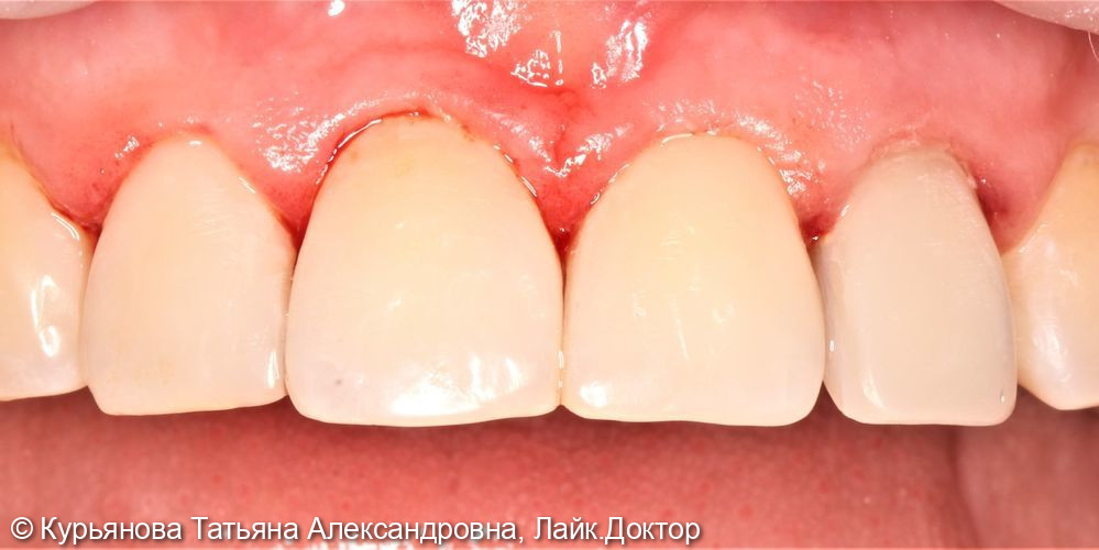 Лечение кариеса передних групп зубов - фото №1
