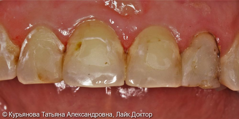 Лечение кариеса передних групп зубов - фото №4