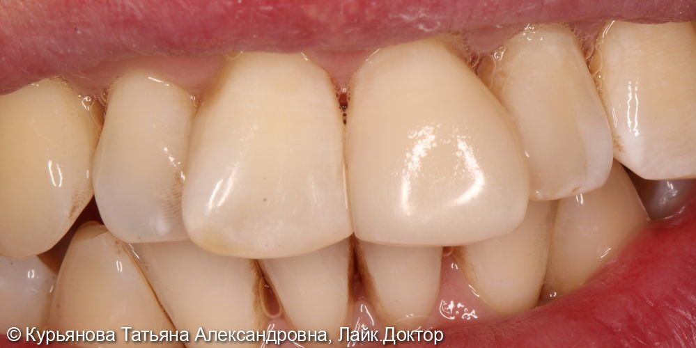 Реставрация переднего зуба - фото №2