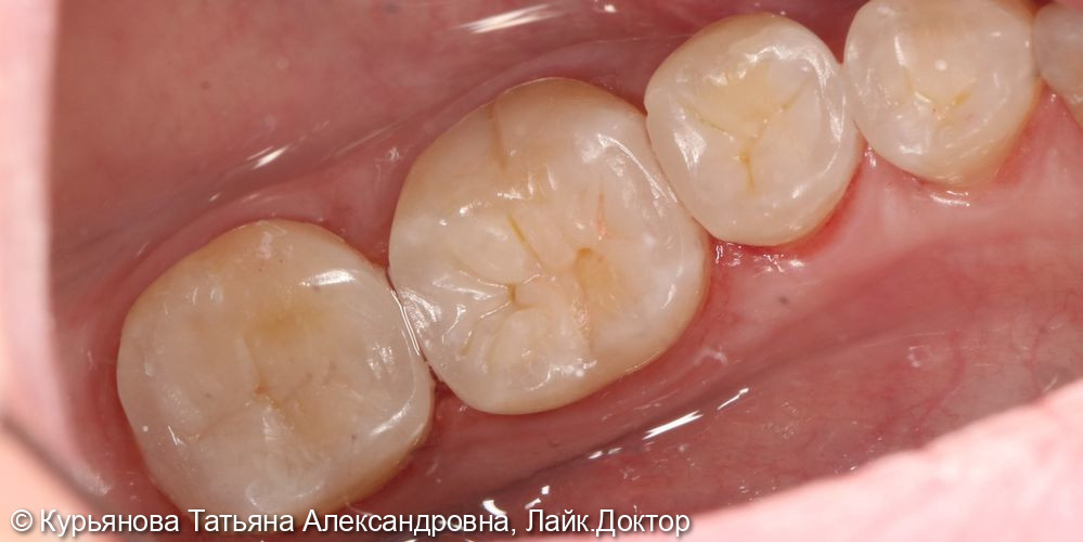 Лечение кариеса зубов - фото №2