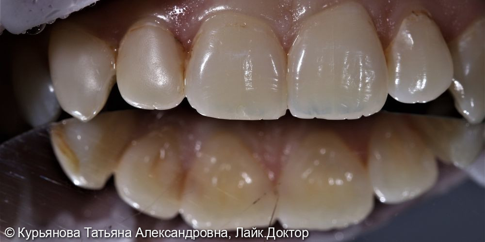 Лечение кариеса передних групп зубов - фото №1