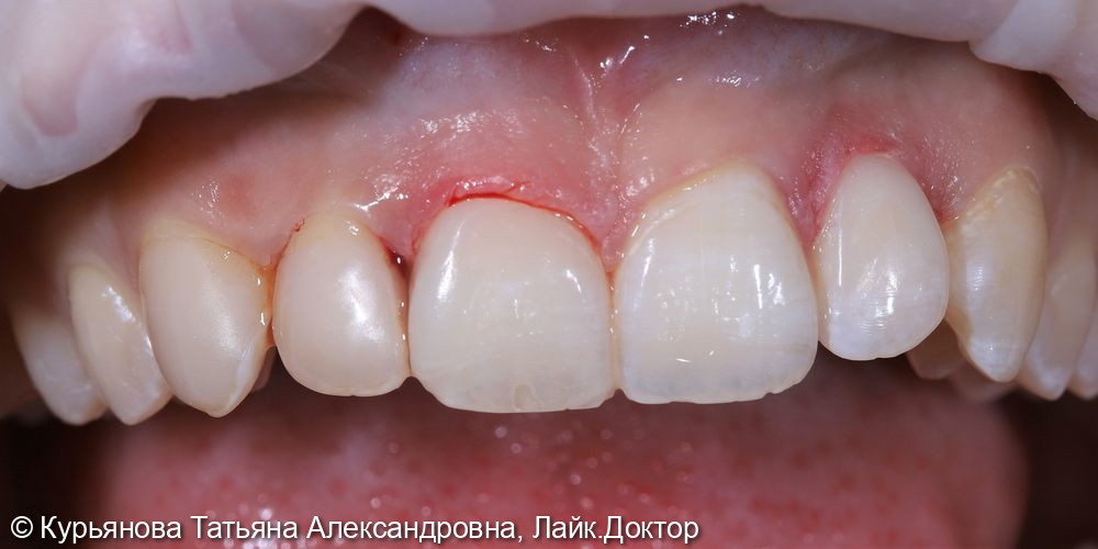 Лечение кариеса передних групп зубов - фото №2