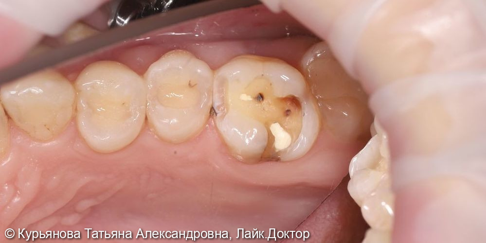 Лечение кариеса фото 2 · Вологда