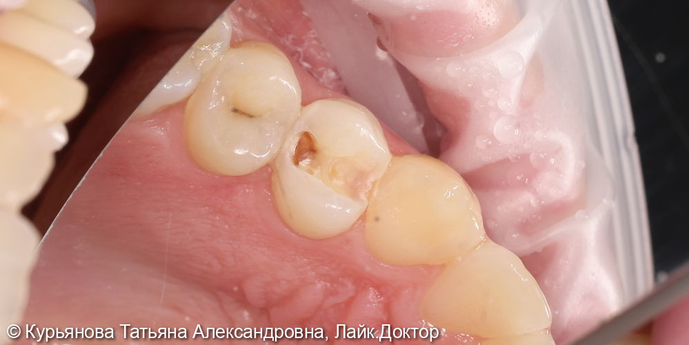лечение кариеса - фото №2