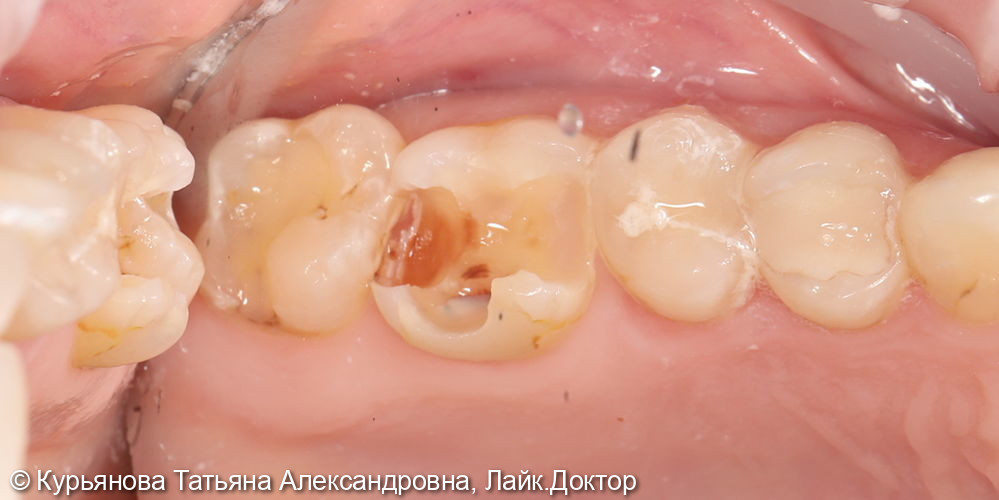 лечение кариеса - фото №2
