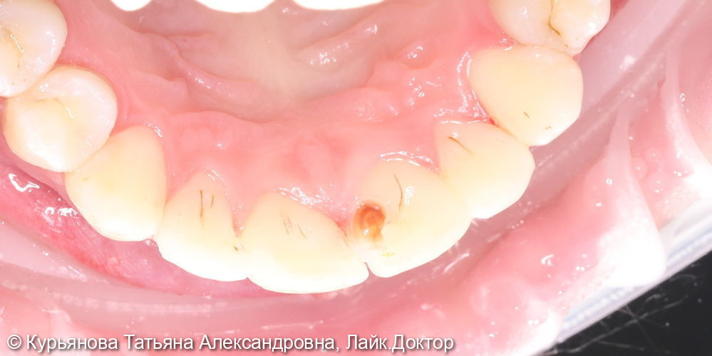 лечение кариеса - фото №2