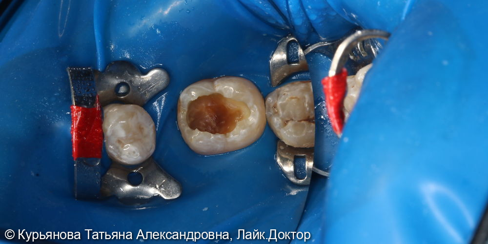 лечение кариеса фото 2 · Вологда
