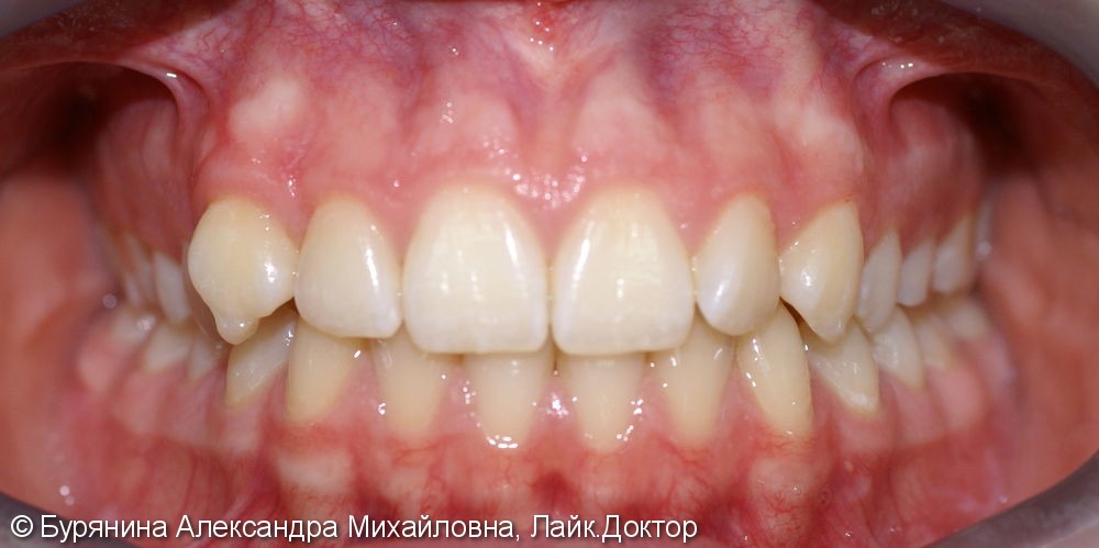 "Неправильный рост" одного из зубов и лёгкая скученность в переднем отделе верхней челюсти - фото №1