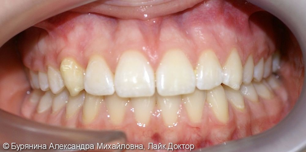 "Неправильный рост" одного из зубов и лёгкая скученность в переднем отделе верхней челюсти - фото №4