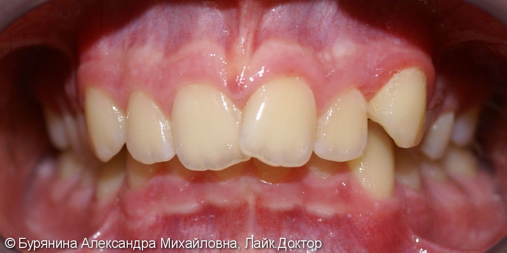 Лечение дистальной окклюзии, выраженной скученности верхнего зубного ряда, сужение верхней челюсти - фото №1
