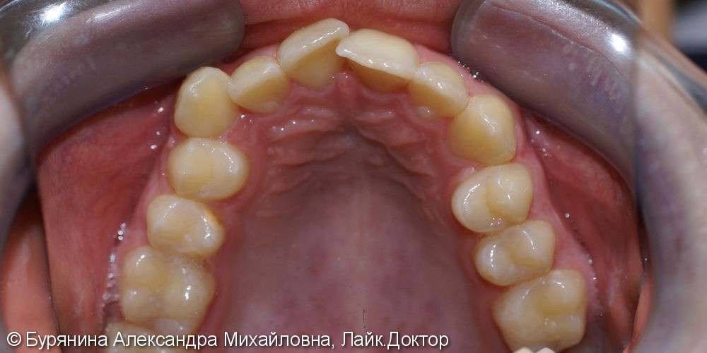 Лечение дистальной окклюзии, выраженной скученности верхнего зубного ряда, сужение верхней челюсти - фото №2