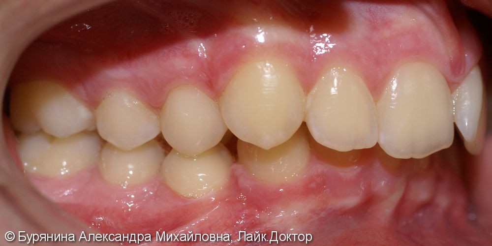 Лечение дистальной окклюзии, выраженной скученности верхнего зубного ряда, сужение верхней челюсти - фото №3
