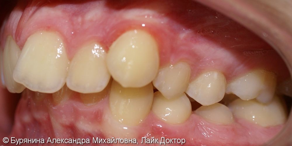 Лечение дистальной окклюзии, выраженной скученности верхнего зубного ряда, сужение верхней челюсти - фото №4