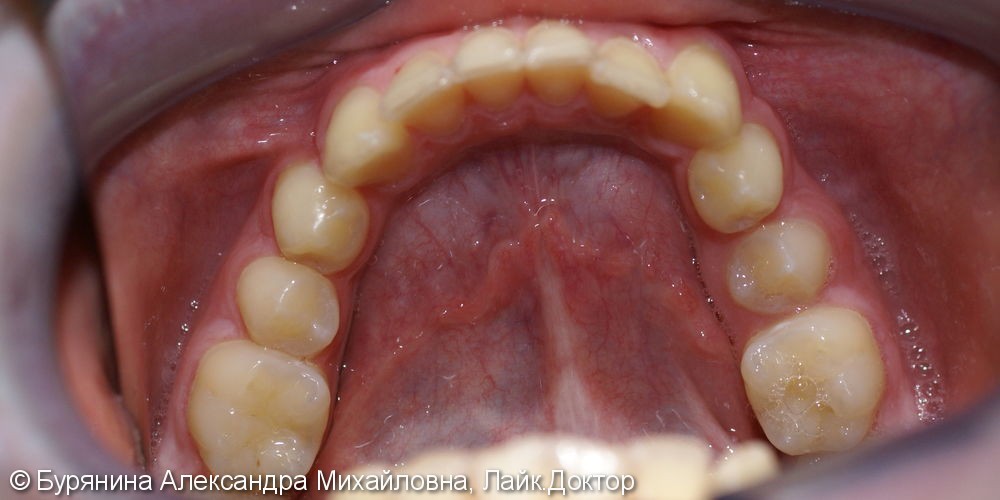 Лечение дистальной окклюзии, выраженной скученности верхнего зубного ряда, сужение верхней челюсти - фото №5