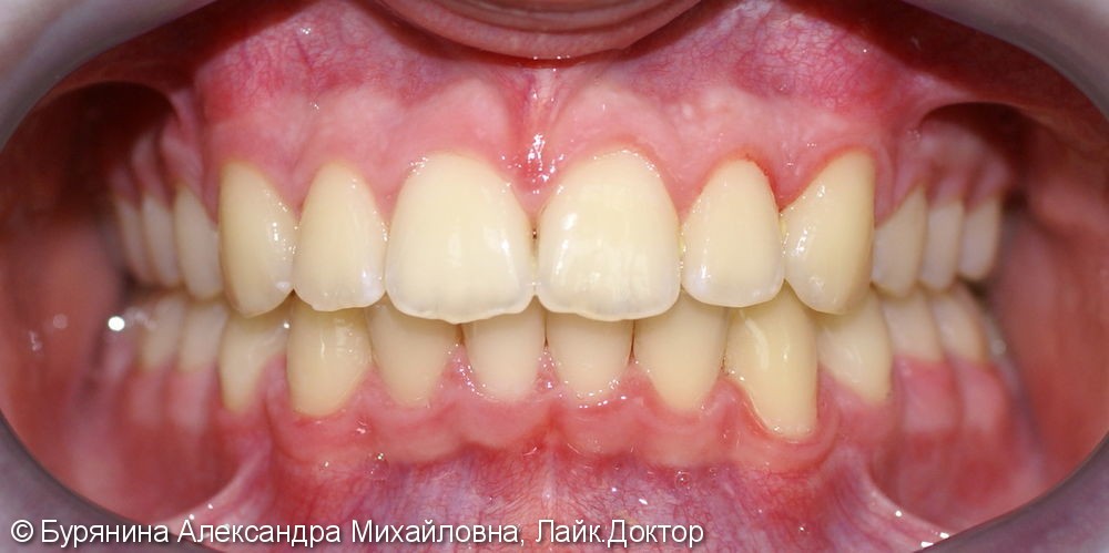 Лечение дистальной окклюзии, выраженной скученности верхнего зубного ряда, сужение верхней челюсти - фото №10