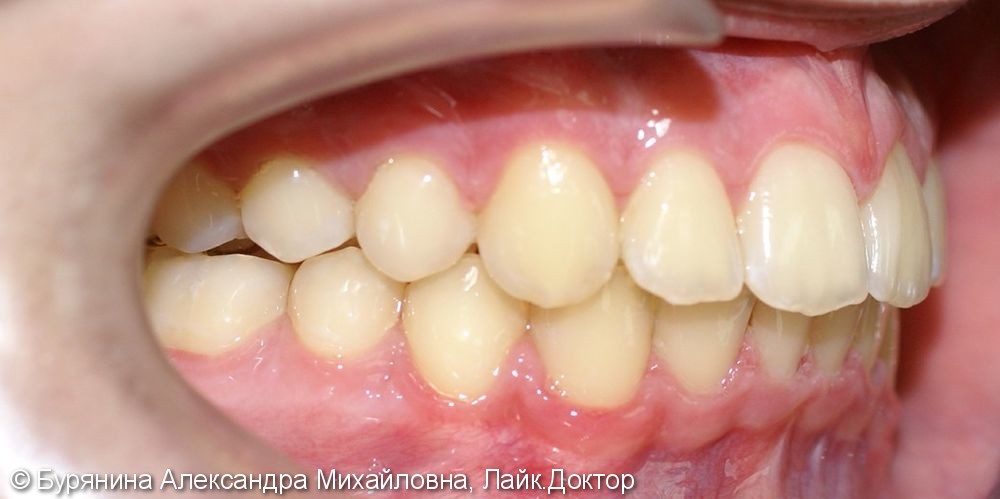 Лечение дистальной окклюзии, выраженной скученности верхнего зубного ряда, сужение верхней челюсти - фото №6