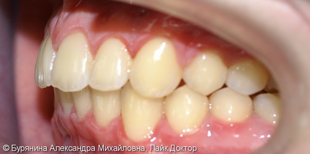 Лечение дистальной окклюзии, выраженной скученности верхнего зубного ряда, сужение верхней челюсти - фото №7