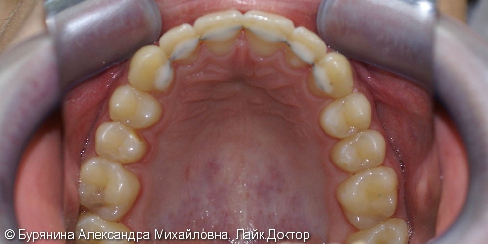 Лечение дистальной окклюзии, выраженной скученности верхнего зубного ряда, сужение верхней челюсти - фото №8