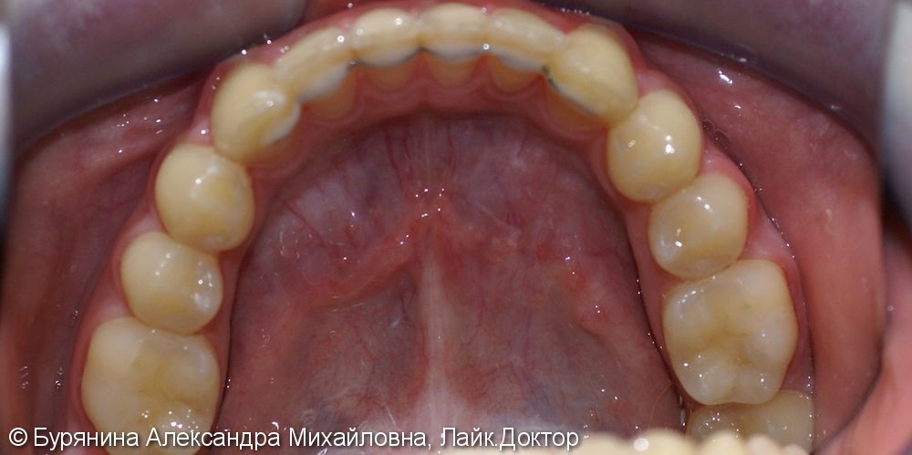Лечение дистальной окклюзии, выраженной скученности верхнего зубного ряда, сужение верхней челюсти - фото №9