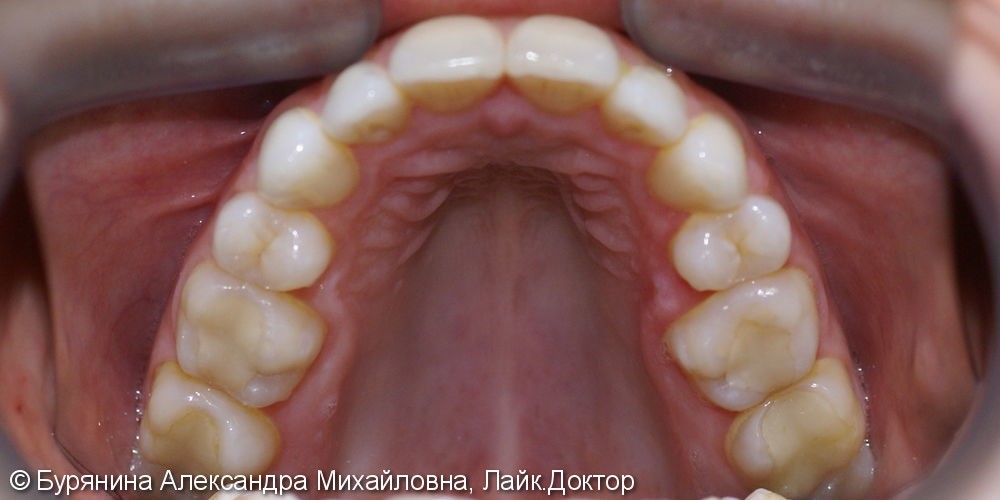 Лечение проводилось на керамической брекет-системе - фото №4