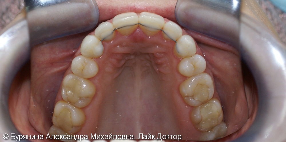 Лечение проводилось на керамической брекет-системе - фото №9