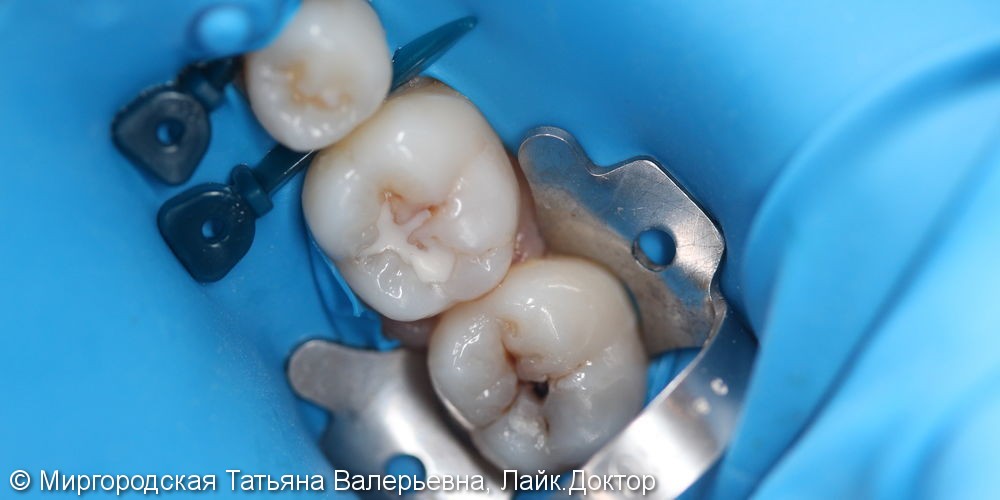 Эстетическая реставрация 36 и 37 зубов с применением нанокомпозита и красок - фото №1