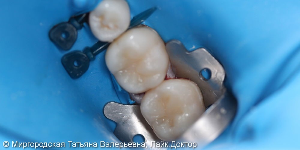 Эстетическая реставрация 36 и 37 зубов с применением нанокомпозита и красок - фото №2