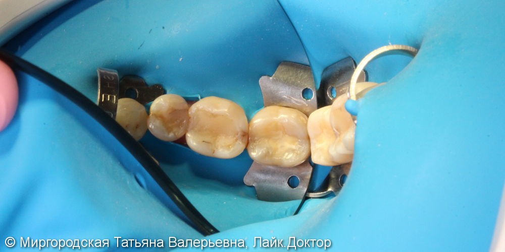Лечение вторичных рецидивирующих кариесов 3-х зубов, до и после - фото №1