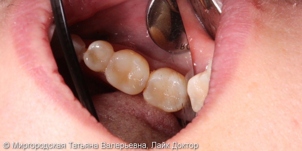 Лечение вторичных рецидивирующих кариесов 3-х зубов, до и после - фото №2