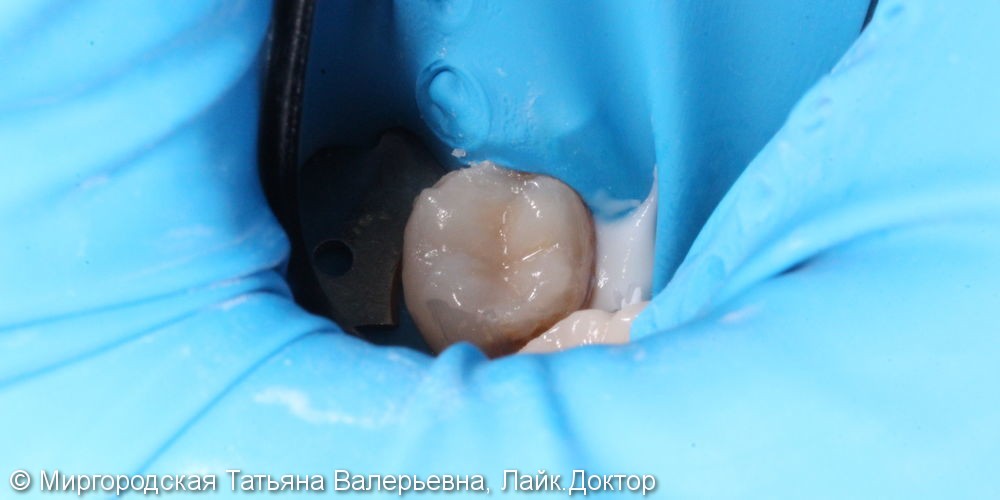 Хронический фиброзный периодонтит 48 зуба: фотографии до и после - фото №4