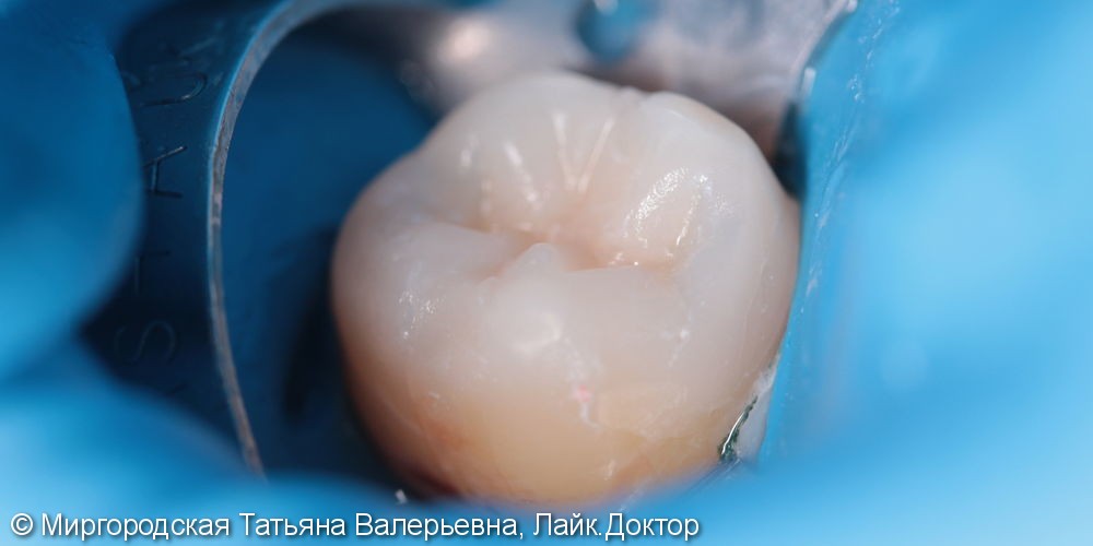 Эстетическая реставрация 47 зуба с применением нанокомпозита и красок - фото №2