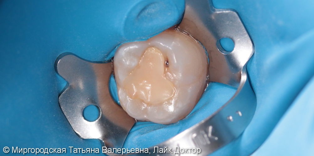 Лечение вторичного рецидивирующего кариеса 37 зуба с применением нанокомпозита и красок - фото №1