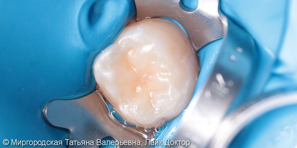 Лечение вторичного рецидивирующего кариеса 37 зуба с применением нанокомпозита и красок - фото №2