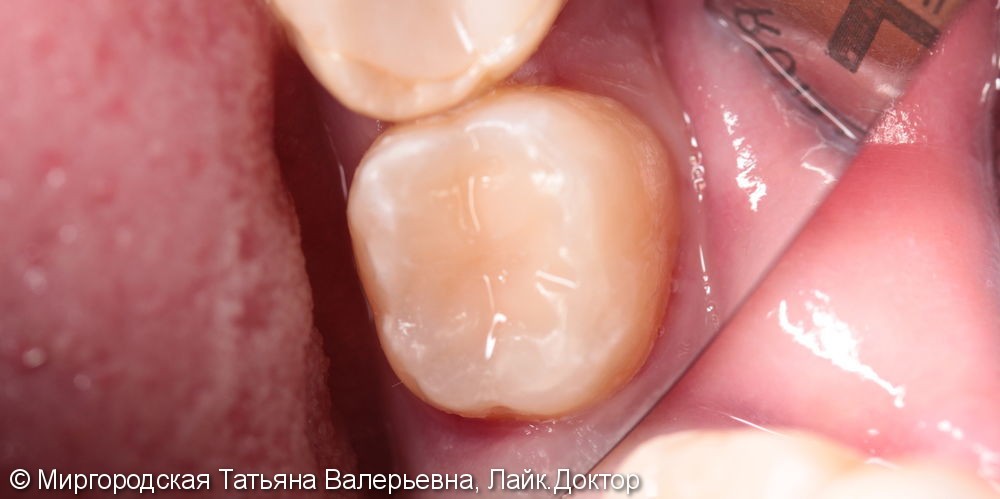 Лечение вторичного рецидивирующего кариеса 37 зуба с применением нанокомпозита и красок - фото №3