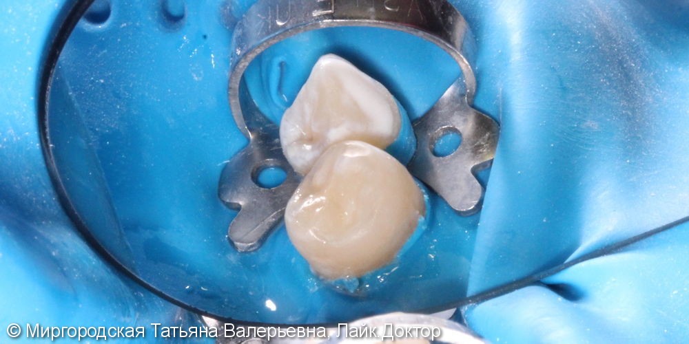 Эстетическая реставрация 35 зуба с применением нанокомпозита и красок - фото №2