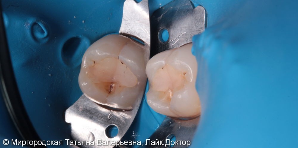 Лечение рецидивирующего кариеса 37 зуба - фото №1