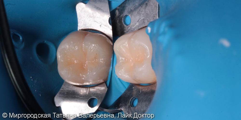 Лечение рецидивирующего кариеса 37 зуба - фото №2