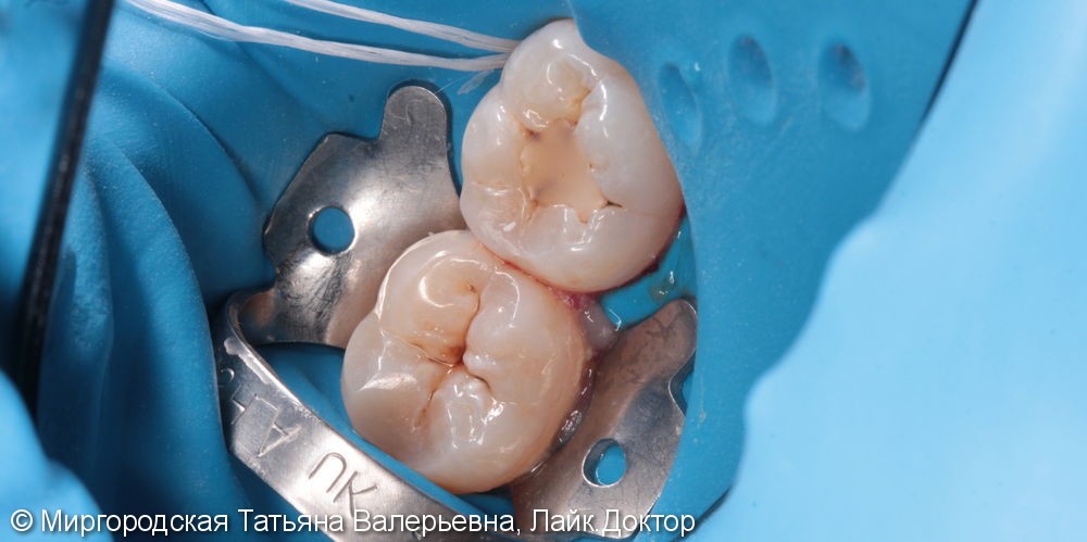 Лечение вторичного кариеса (рецидивирующего) - 46 и 47 зубов - фото №1