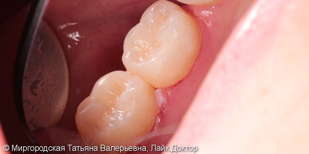 Лечение вторичного кариеса (рецидивирующего) - 46 и 47 зубов - фото №3