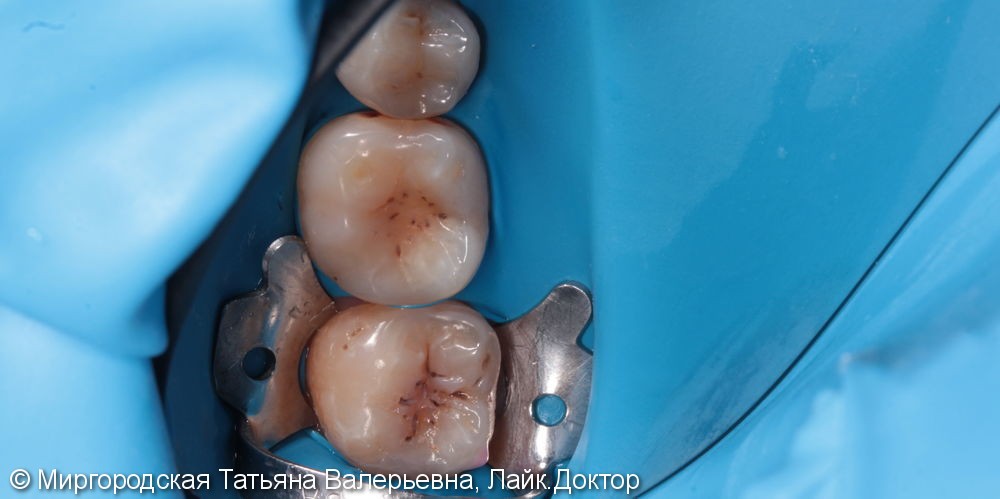 Лечение вторичного кариеса сразу двух зубов - фото №1