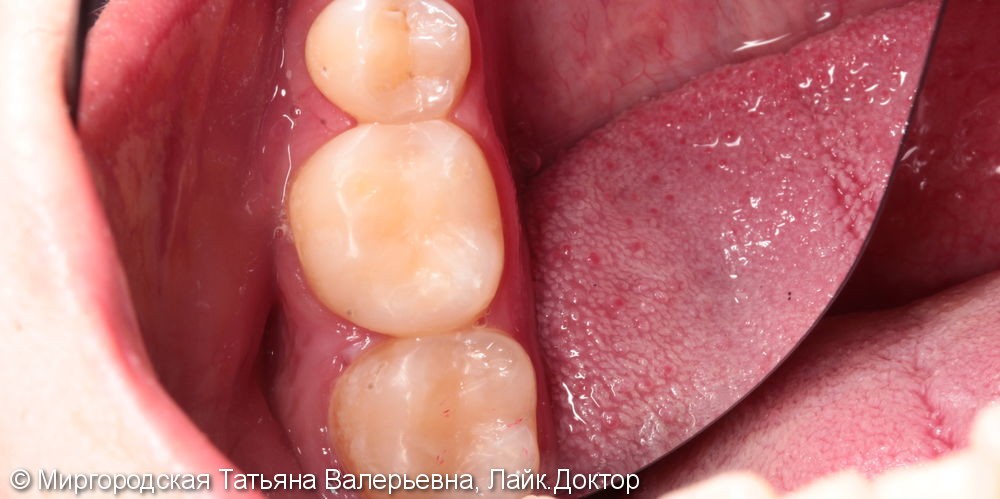 Лечение вторичного кариеса сразу двух зубов - фото №3