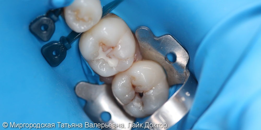 Проведена эстетическая реставрация 36 и 37 зубов с применением нанокомпозита и красок последнего поколения - фото №1